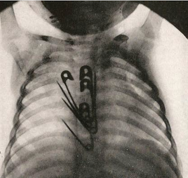 Illustration for article titled People Swallow the Darndest Things: Cigarette Butts, Burnt Matches and More
